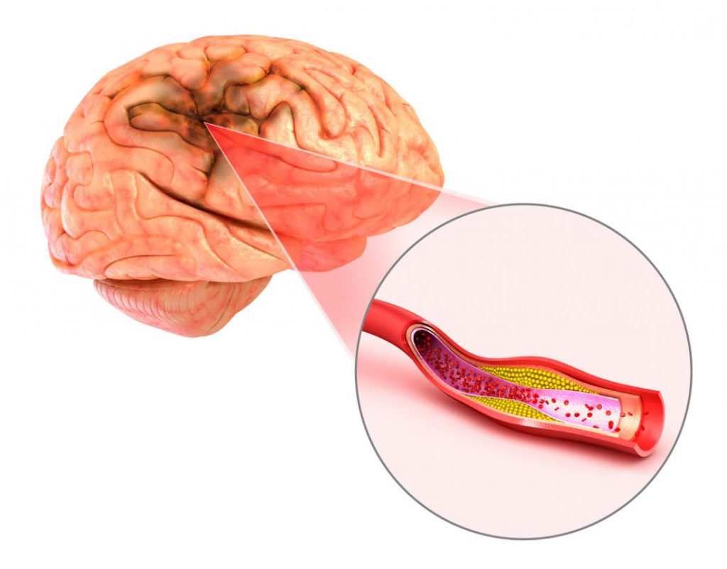 Brain hemorrhage