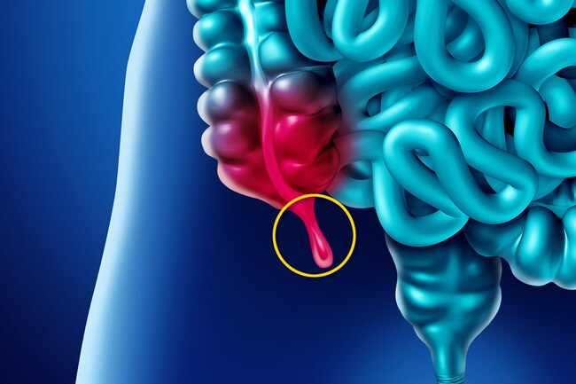 अप ड क स Appendix लक षण पहच न पर क षण तथ उपच र Appendix